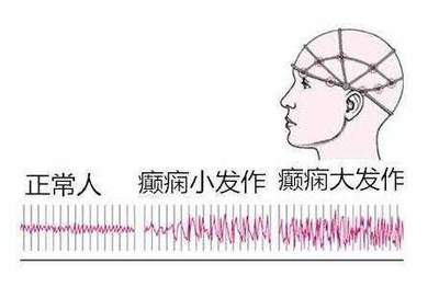 我国抗癫痫技术取得世界领先新突破 为患者带来新曙光